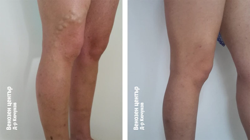 EVLA + склеротерапия