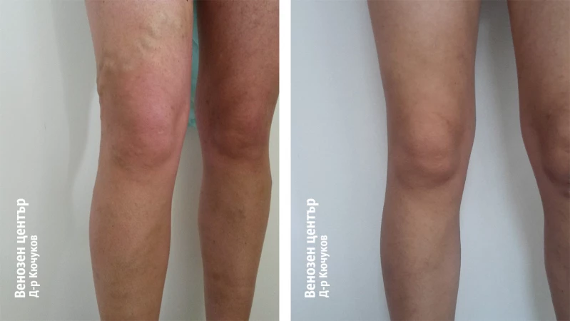 EVLA + склеротерапия