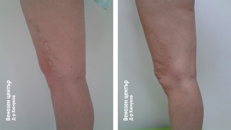 Микрофлебектомия