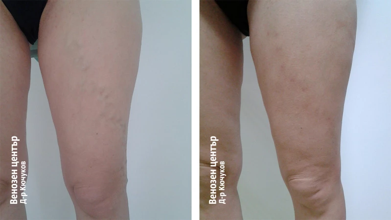 Микрофлебектомия
