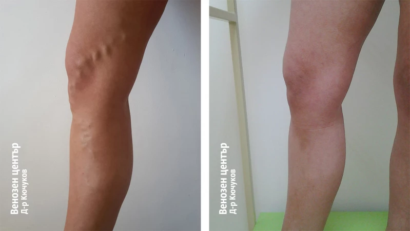 EVLA + склеротерапия