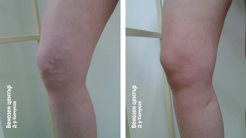 EVLA + склеротерапия