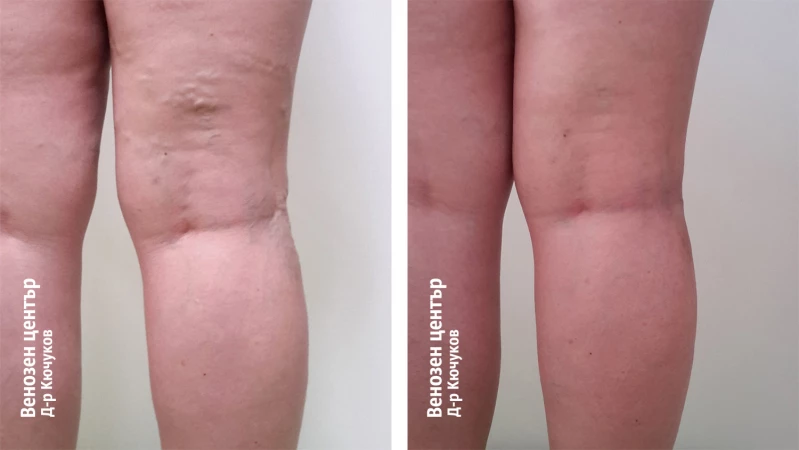 Склеротерапия