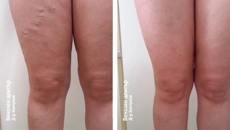 Склеротерапия