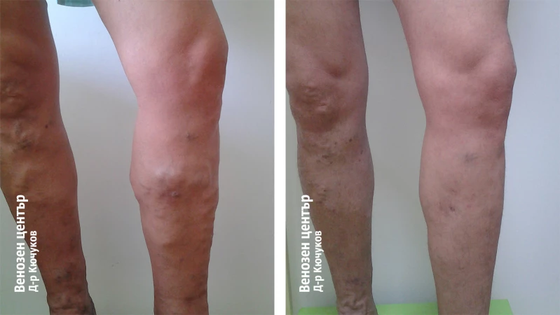 EVLA + микрофлебектомия