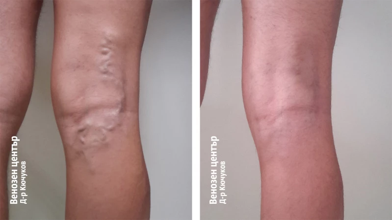 Склеротерапия