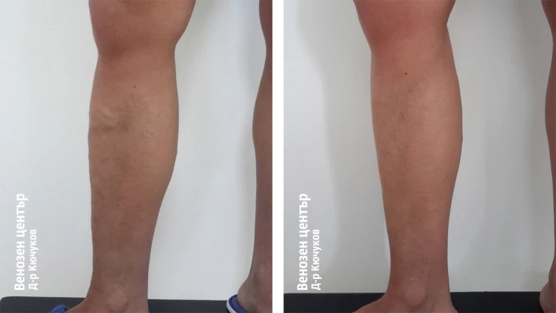 EVLA + склеротерапия