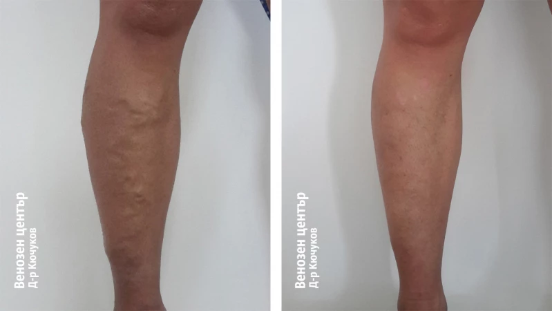 EVLA + склеротерапия