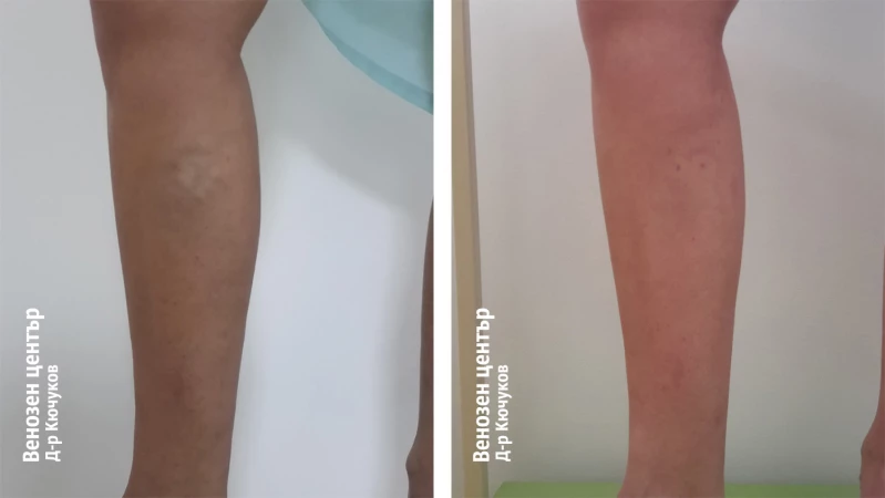 EVLA + микрофлебектомия