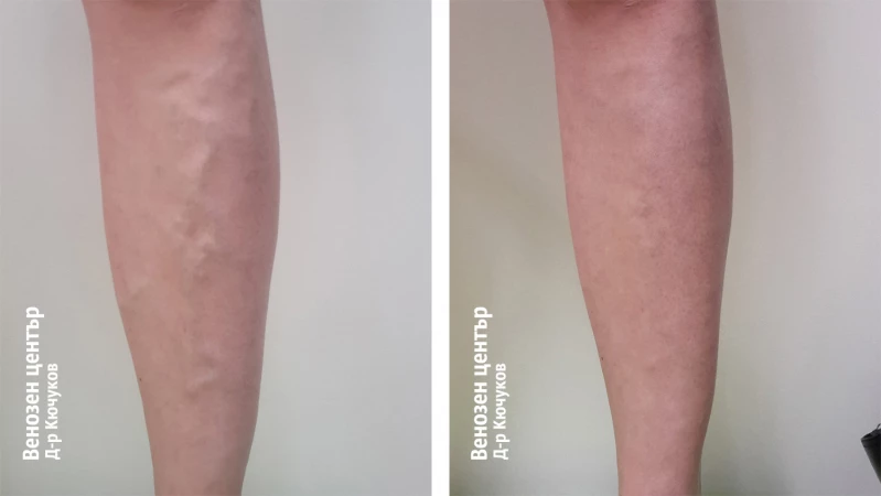 Склеротерапия