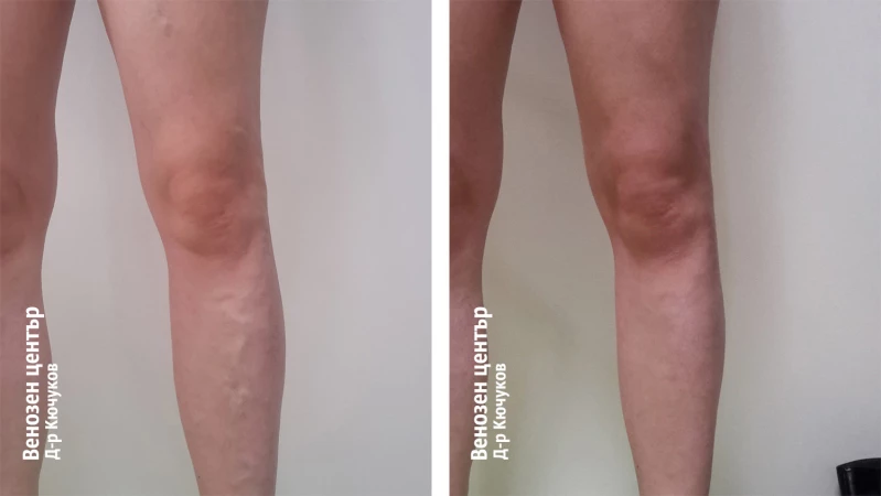 Склеротерапия