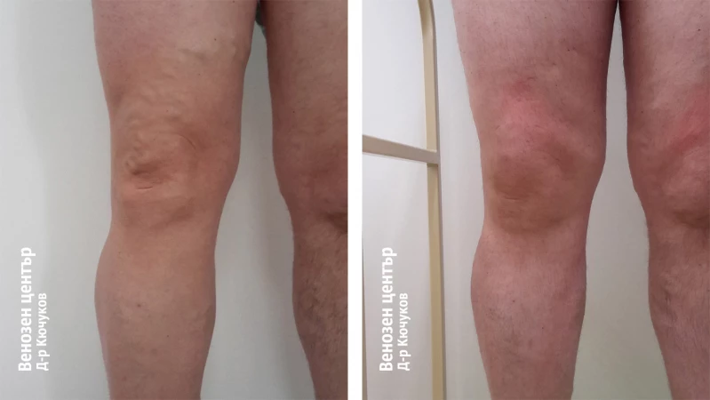 EVLA + микрофлебектомия