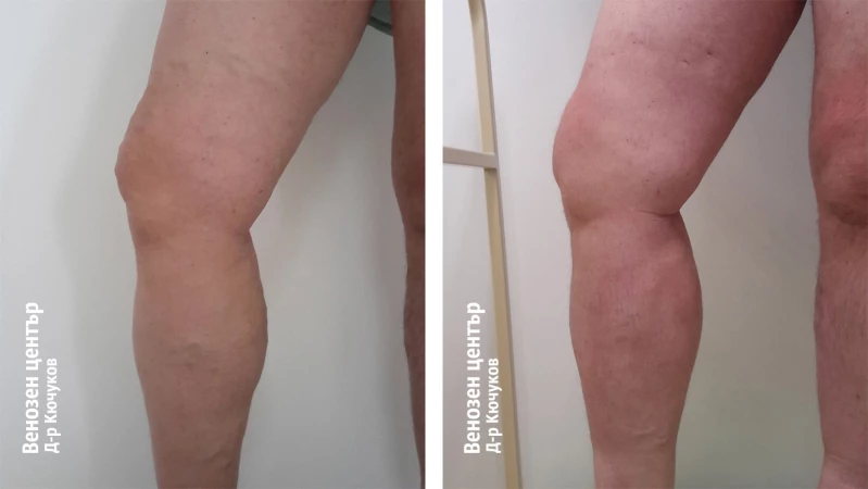 EVLA + микрофлебектомия