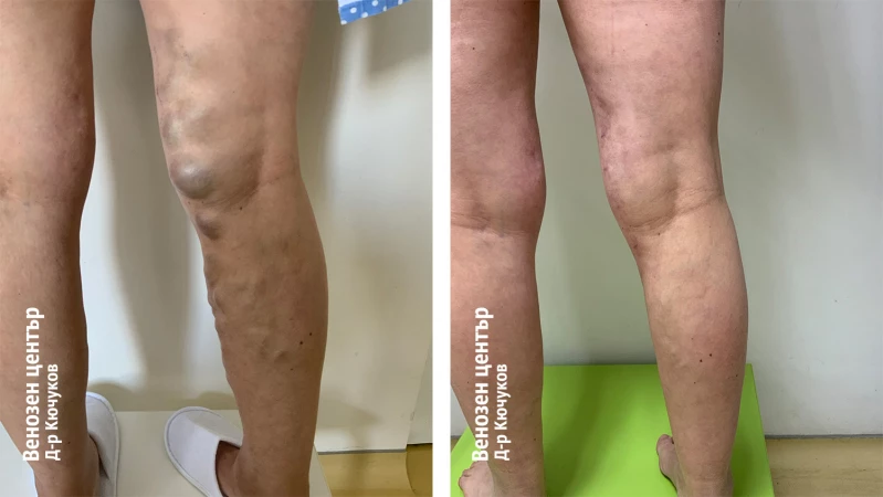 EVLA + микрофлебектомия + склеротерапия
