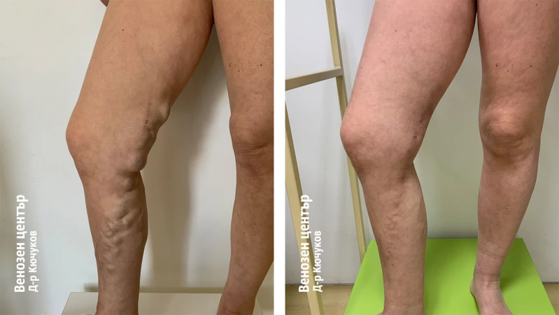 EVLA + микрофлебектомия + склеротерапия
