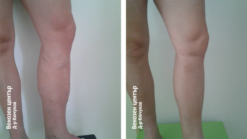 Микрофлебектомия