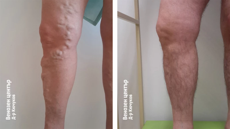 EVLA + склеротерапия
