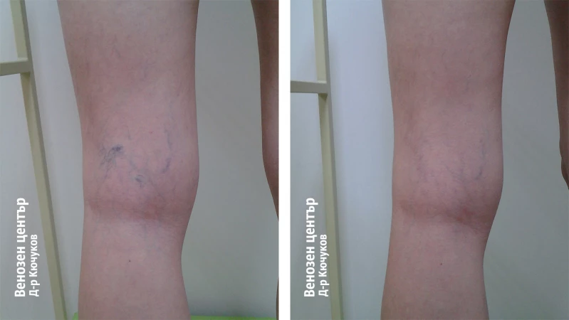 Микросклеротерапия